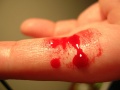 1024px-Bleeding finger.jpg